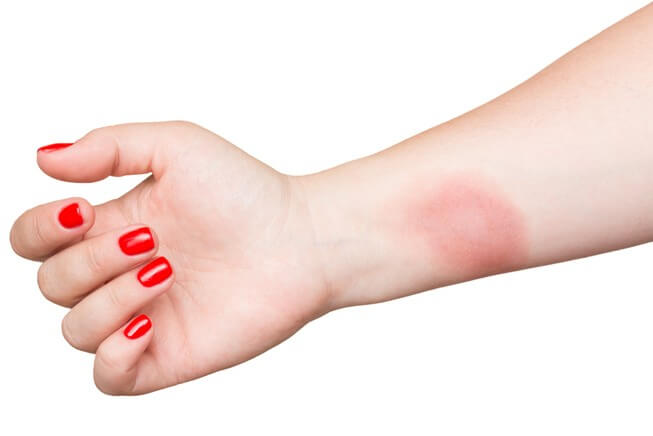 Woman's arm showing burn scar injury 