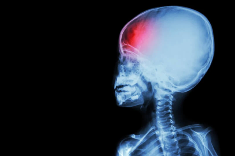 X-ray showing brain injury